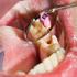 چه دلایلی موجب آسیب به عصب دندان می‌شوند؟